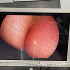 Circon Acmi Lap 5-30 MA Rigid Laparoscope 30 degree (Used) - ACMI -Angelus Medical
