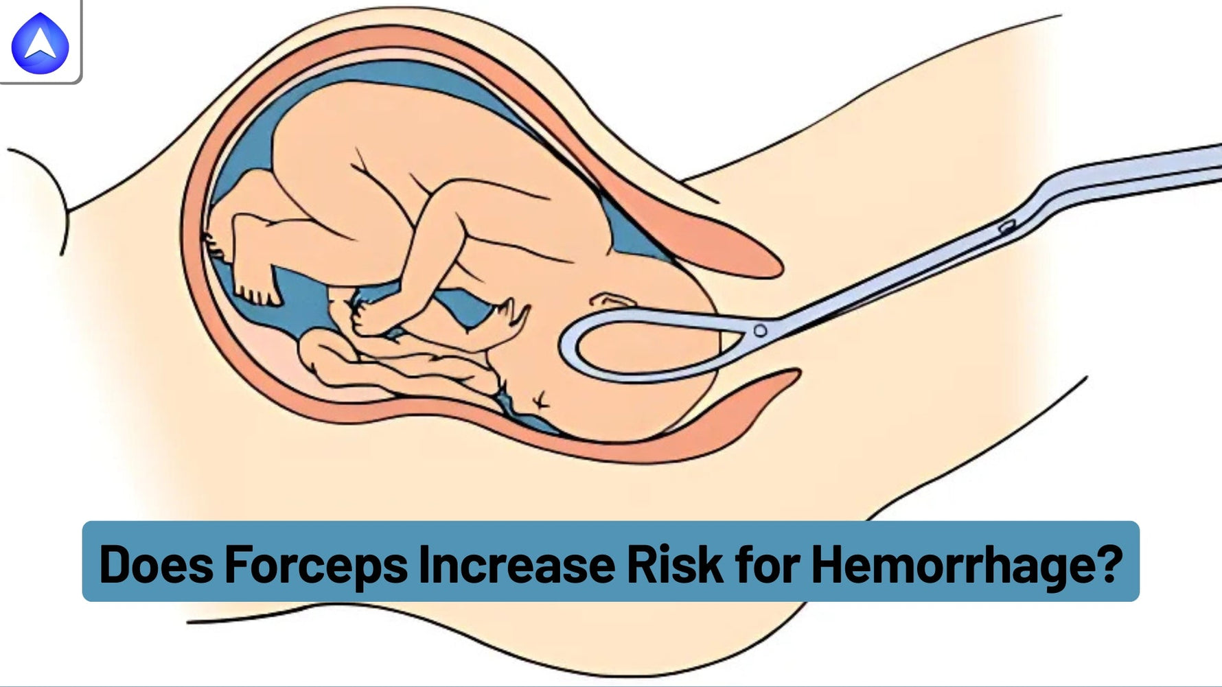 Does Forceps Increase Risk for Hemorrhage?