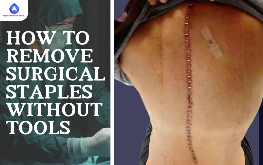 How to Remove Surgical Staples Without Tools
